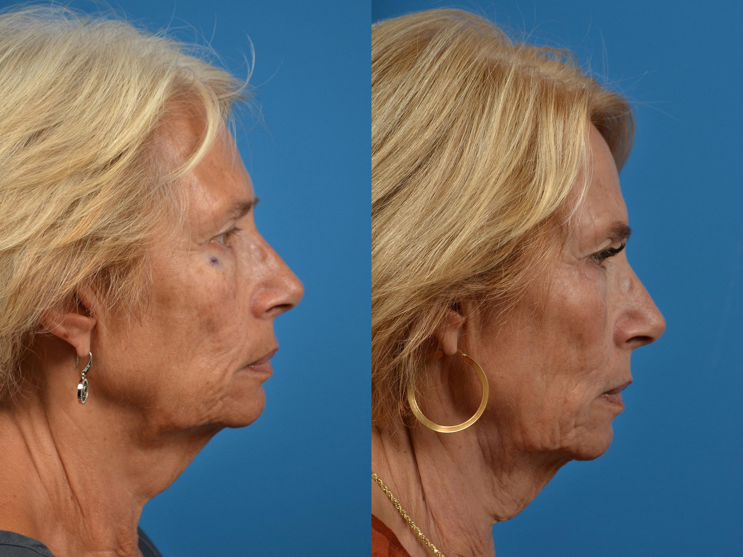Mohs Surgery And Skin Cancer Photos Melbourne Fl Patient 55412